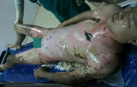 Điều trị thành công bệnh nhân bỏng 90% diện tích cơ thể, biến chứng nhiễm khuẩn huyết, suy hô hấp cấp tiến triển